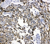 IHC-P: GRP75 antibody testing of human lung cancer tissue. HIER: steamed with pH6 citrate buffer.