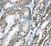 IHC-P: HSP10 antibody testing of human intestinal cancer tissue