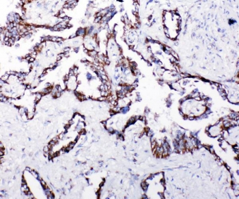 IHC staining of FFPE human lung cancer with HSP10 antibody. HIER: boil tissue sections in pH8 EDTA for 20 min and allow to cool before testing.