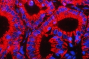 Immunofluorescent staining of FFPE human intestinal cancer with HSP10 antibody (red) and DAPI nuclear counterstain (blue). HIER: boil tissue sections in pH6, 10mM citrate buffer, for 10-20 min followed by cooling at RT for 20 min.