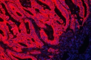Immunofluorescent staining of FFPE human intestinal cancer with HSP10 antibody (red) and DAPI nuclear counterstain (blue). HIER: boil tissue sections in pH8 EDTA for 10-20 min followed by cooling at RT for 20 min.