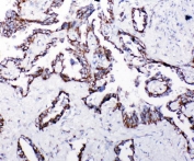 IHC staining of FFPE human lung cancer with HSP10 antibody. HIER: boil tissue sections in pH8 EDTA for 20 min and allow to cool before testing.