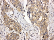 IHC-P: LASP1 antibody testing of human lung cancer tissue