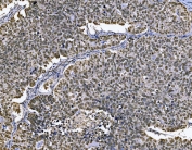 IHC staining of FFPE human ovarian serous adenocarcinoma tissue with MCM7 antibody. HIER: boil tissue sections in pH8 EDTA for 20 min and allow to cool before testing.