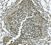 IHC staining of FFPE human bladder cancer tissue with MCM7 antibody. HIER: boil tissue sections in pH8 EDTA for 20 min and allow to cool before testing.