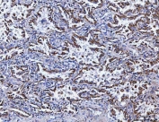 IHC staining of FFPE human lung cancer tissue with SSR3 antibody. HIER: boil tissue sections in pH8 EDTA for 20 min and allow to cool before testing.