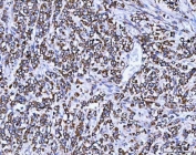 IHC staining of FFPE human breast cancer tissue with SSR3 antibody. HIER: boil tissue sections in pH8 EDTA for 20 min and allow to cool before testing.