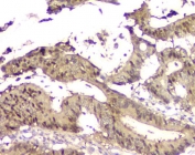 IHC staining of FFPE human intestinal cancer with 14-3-3 sigma antibody. HIER: boil tissue sections in pH8 EDTA for 20 min and allow to cool before testing.
