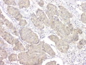 IHC staining of FFPE human breast cancer with 14-3-3 sigma antibody. HIER: boil tissue sections in pH8 EDTA for 20 min and allow to cool before testing.