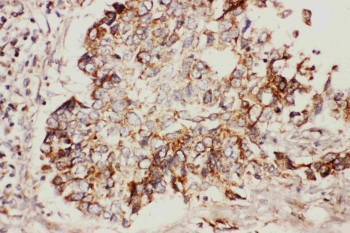 IHC staining of FFPE human lung cancer with HSPB1 antibody. HIER: boil tissue sections in pH6, 10mM citrate buffer, for 10-20 min followed by cooling at RT for 20 min.