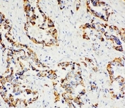 IHC staining of FFPE human lung cancer tissue with Paxillin antibody.