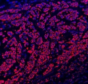 Immunofluorescent staining of FFPE human breast cancer tissue with Paxillin antibody (red) and DAPI nuclear stain (blue). HIER: steam section in pH8 EDTA buffer for 20 min.