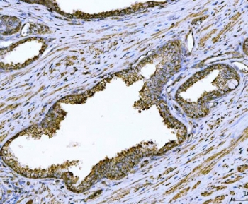 IHC staining of FFPE human prostate cancer tissue with Arg2 antibody. HIER: boil tissue sections in pH8 EDTA for 20 min and allow to cool before testing.~