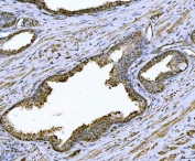 IHC staining of FFPE human prostate cancer tissue with Arg2 antibody. HIER: boil tissue sections in pH8 EDTA for 20 min and allow to cool before testing.
