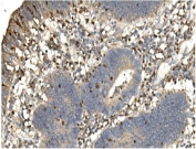 IHC staining of FFPE human rectal cancer with Daxx antibody. HIER: boil tissue sections in pH8 EDTA for 20 min and allow to cool before testing.
