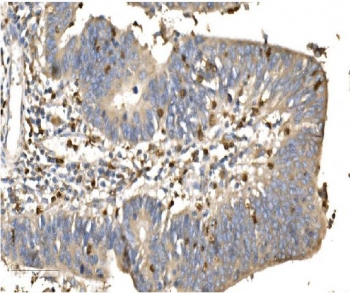 IHC staining of FFPE human rectal cancer with Daxx antibody. HIER: boil tissue sections in pH8 EDTA for 20 min and allow to cool before testing.