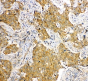 IHC staining of FFPE human lung cancer with HSPA8 antibody. HIER: boil tissue sections in pH6, 10mM citrate buffer, for 20 min and allow to cool before testing.