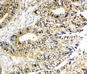 IHC-P: NME2 antibody testing of human intestinal cancer tissue