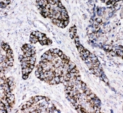 IHC staining of FFPE human lung cancer tissue with Peroxiredoxin 3 antibody. HIER: boil tissue sections in pH8 EDTA for 20 min and allow to cool before testing.