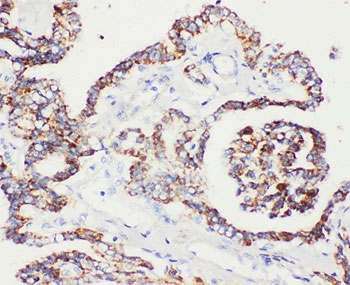 IHC-P: Peroxiredoxin 5 antibody testing of human prostatic cancer tissue