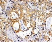 IHC-P: SDHC antibody testing of human gastric cancer tissue