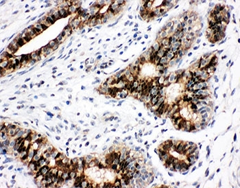 IHC-P: STAT5b antibody testing of human breast cancer tissue