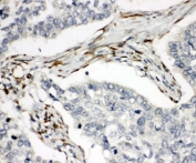 IHC-P: TRAIL R2 antibody testing of human lung cancer tissue