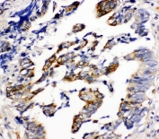 IHC-P: Beta Arrestin 2 antibody testing of human intestinal cancer tissue. HIER: steamed with pH6 citrate buffer.