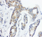 IHC-P: CD1d antibody testing of human breast cancer tissue