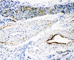 IHC-P: HYAL3 antibody testing of human breast cancer tissue