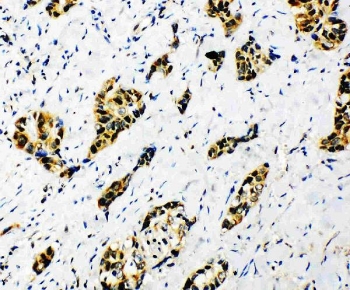 IHC staining of FFPE human lung cancer tissue with Splicing factor 1 antibody. HIER: boil tissue sections in pH8 EDTA for 20 min and allow to cool before testing.