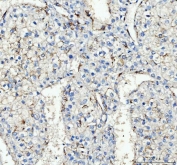 IHC staining of FFPE human liver cancer tissue with CD163 antibody. HIER: boil tissue sections in pH8 EDTA for 20 min and allow to cool before testing.