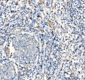 IHC staining of FFPE human lung cancer tissue with CD163 antibody. HIER: boil tissue sections in pH8 EDTA for 20 min and allow to cool before testing.
