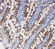 IHC-P: FER antibody testing of human intestinal cancer tissue. HIER: steamed with pH6 citrate buffer.