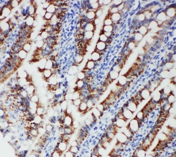 IHC-P: FER antibody testing of human intestinal cancer tissue