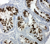IHC-P: p107 antibody testing of human intestinal cancer tissue