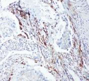 IHC-P: SHC1 antibody testing of human lung cancer tissue. HIER: steamed with pH6 citrate buffer.