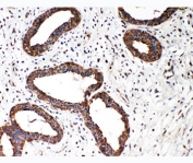 IHC-P: Smad2 antibody testing of human breast cancer tissue. HIER: steamed with pH6 citrate buffer.