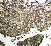 IHC-P: TXNRD2 antibody testing of human lung cancer tissue