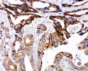 IHC-P: DCC antibody testing of human intestinal cancer tissue.
