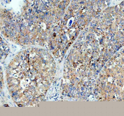 Immunohistochemical staining of FFPE human liver cancer tissue with MALT1 antibody, HRP-secondary and DAB substrate. HIER: boil tissue sections in pH8 EDTA for 20 min and allow to cool before testing.