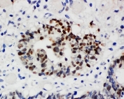 IHC-P: Nucleophosmin antibody testing of human intestinal cancer tissue. HIER: steamed with pH6 citrate buffer.