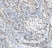 IHC staining of FFPE human laryngeal squamous cell carcinoma tissue with Nucleophosmin antibody. HIER: boil tissue sections in pH8 EDTA for 20 min and allow to cool before testing.
