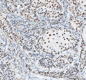 IHC-P: Nucleophosmin antibody testing of human intestinal cancer tissue. HIER: steamed with pH6 citrate buffer.