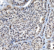 IHC staining of FFPE human liver cancer tissue with Nucleophosmin antibody. HIER: boil tissue sections in pH8 EDTA for 20 min and allow to cool before testing.