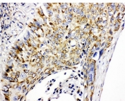 IHC-P: Prohibitin antibody testing of human lung cancer tissue