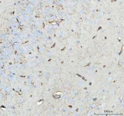 IHC-P: Aquaporin 4 antibody testing of human lung cancer tissue. HIER: steamed with pH6 citrate buffer.