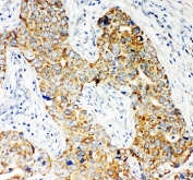 IHC-P: NOX5 antibody testing of human breast cancer tissue