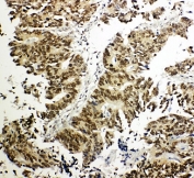IHC-P: NRF1 antibody testing of human intestinal cancer tissue