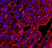 Immunofluorescent staining of FFPE human liver cancer tissue with CD31 antibody (red) and DAPI nuclear stain (blue). HIER: steam section in pH8 EDTA buffer for 20 min.